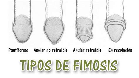 fimosis imagenes|Los 5 Tipos de Fimosis